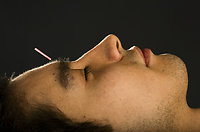 Acupuncture. acu man face